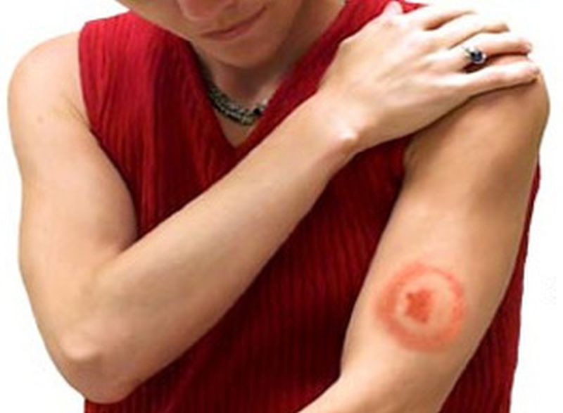 Viaţa sănătoasă – Primul ajutor în cazul înțepăturii de căpușă