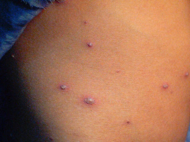 Piţian, DSP: „Nu este focar de varicelă!”