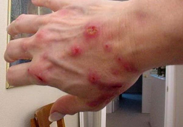 Reprezentanţii DSP sfătuiesc populaţia să se ferească de căpuşe