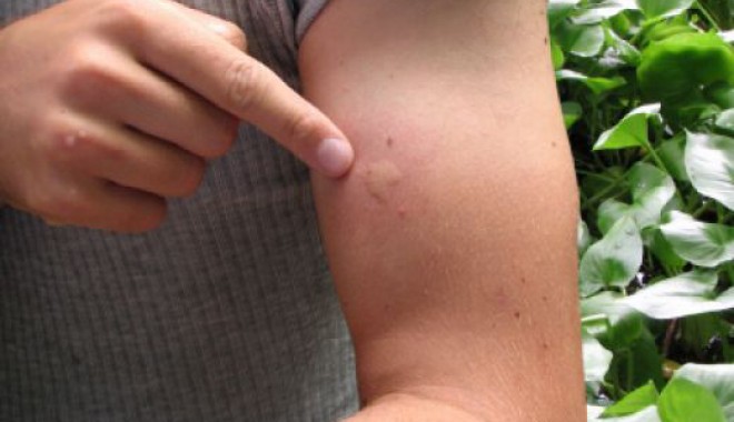 Gorjenii sunt sfătuiţi să evite expunerea la ţânţari