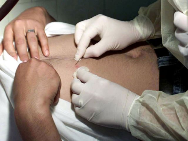 Medicii SJU îngrijesc, zilnic, câteva persoane muşcate de căpuşe