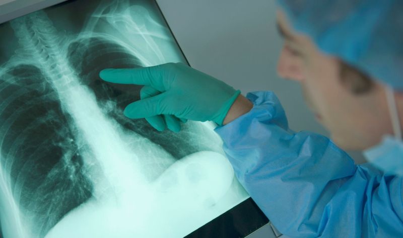 Peste 2200 de gorjeni suferă de cancer bronhopulmonar