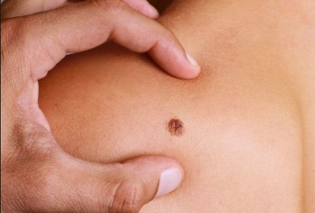 Testări gratuite pentru alunițele suspecte