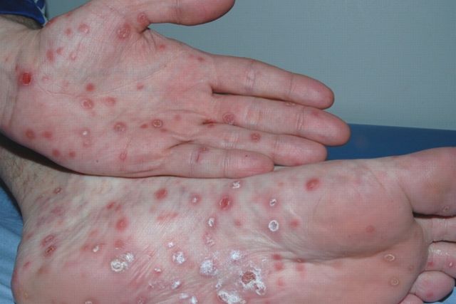 Noi cazuri de sifilis, confirmate în Gorj