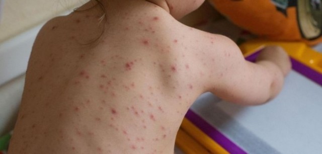Numărul cazurilor de rujeolă, în scădere