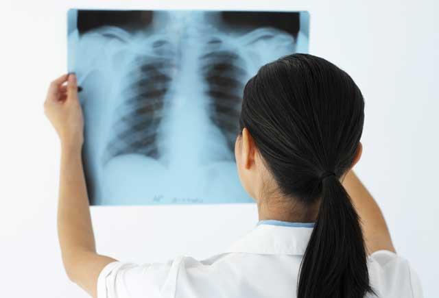 Aproape 600 de gorjeni suferă de cancer bronhopulmonar