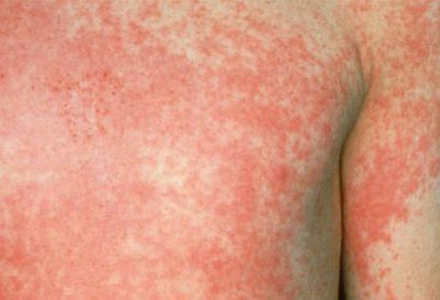 Opt cazuri de scarlatină în Gorj