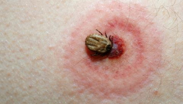 Medicii SJU au îngrijit 60 de gorjeni mușcați de căpușe