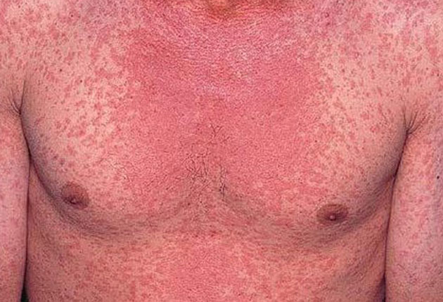 Continuă să crească numărul cazurilor de rujeolă