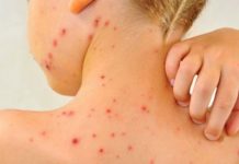 Noi cazuri de rujeolă, confirmate în mai multe județe