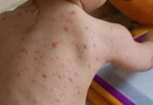 Zeci de cazuri noi de rujeolă