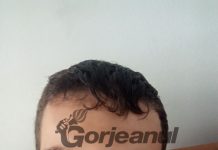 Medicul radiolog de la SJU a repetat examinarea pentru tânărul agresat! De data aceasta, diagnosticul a fost FRACTURĂ de piramidă nazală