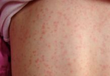 80 de cazuri noi de rujeolă, confirmate în ultima săptămână