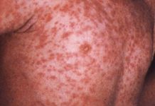 Zeci de noi cazuri de rujeolă