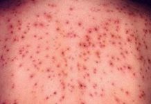 85 de noi cazuri de rujeolă, dintre care unul fiind confirmat în Gorj