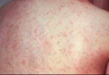 Noi cazuri de rujeolă, confirmate în ultima săptămână