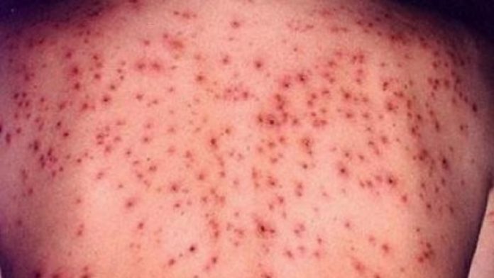 Circa o mie de noi cazuri de rujeolă