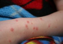 Rafila: Epidemia de rujeolă evoluează în continuare în România