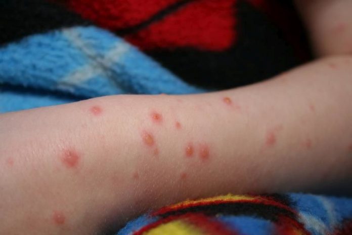 Rafila: Epidemia de rujeolă evoluează în continuare în România