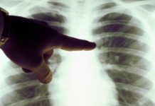 195 de gorjeni, diagnosticați cu TBC