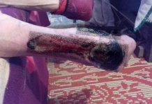 Asistenții comunitari din Albeni, din neștiință, fac pe doctorii! Ei tratează, la domiciliu, piciorul cangrenat al unui localnic