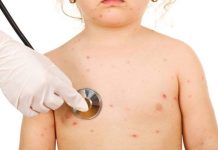 Cazuri noi de rujeolă. Gorjul, pe listă!