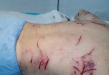 Miner desfigurat de câinii fără stăpân din Valea Jiului!