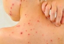 DSP Gorj face lumină: Sunt 53 de cazuri de varicelă în Târgu-Jiu şi Runcu!