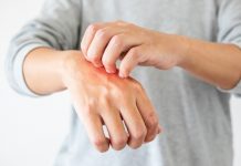 Se poate trata psoriazisul?