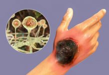 Un alt pericol! Ciuperca neagră la pacienții post-Covid