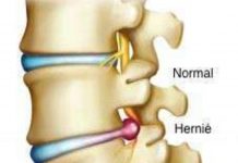 Sfaturi pentru prevenirea herniei de disc