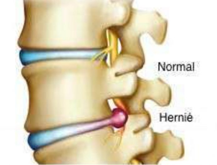 hernie disc