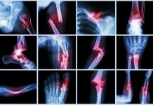 Tipuri de fracturi – cauze și tratament