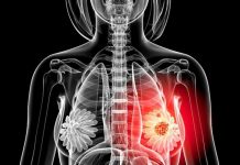 Circa 1.500 de cazuri de cancer mamar, anul trecut, în Gorj