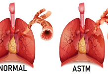 Astmul bronșic – cauze, simptome, tratament