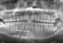 S-a prezentat la Poliția Motru cu maxilarul spart și cu Petcu Jr. urmărindu-l cu un cuțit