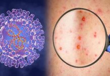 Un nou caz de variola maimuţei