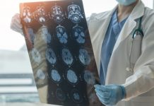 A suferit un grav accident vascular la 31 de ani. Medic: A fost cea mai tânără pacientă pe care am trombolizat-o