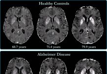 Totul despre tulburările deteriorativ-demențiale