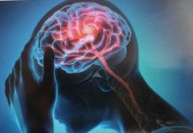 Ministerul Sănătății: Anual, peste 60.000 de români suferă un AVC