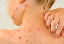 Cinci cazuri de rujeolă în Gorj