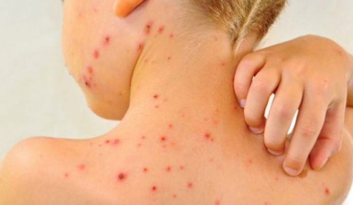 rujeola-1