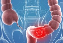Cancerul colorectal – cel mai frecvent tip de cancer diagnosticat în România