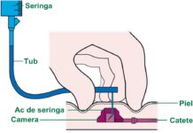 ABC Gorj: Camere implantabile pentru bolnavii de cancer