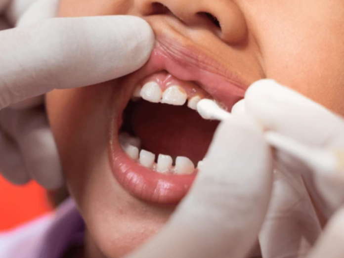 fluorizare dentara copii-city dental clinic